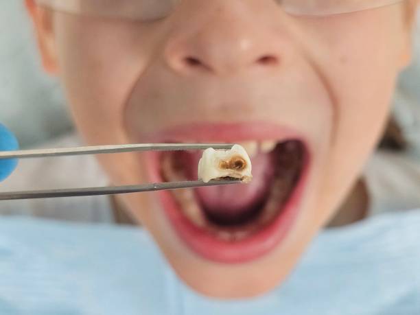 Best Emergency Wisdom Teeth Removal in Carroll Valley, PA